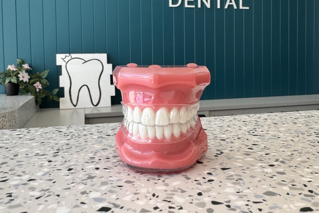 An example of Clear Aligners